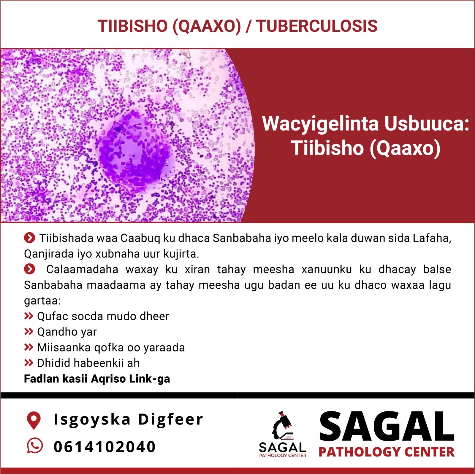 Tiibisho (Qaaxo): Tuberculosis